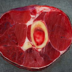 Torbiel samotna kości