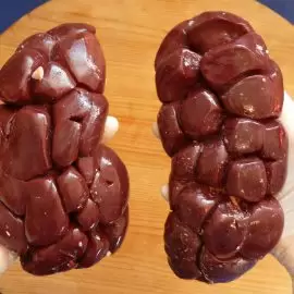 Kłębuszkowe zapalenie nerek