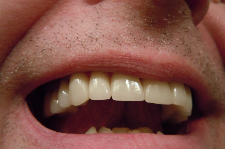 Zespół pieczenia jamy ustnej