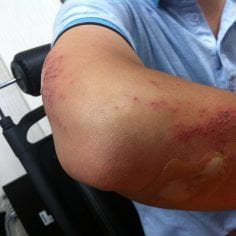 Jak pozbyć się siniaków na ciele